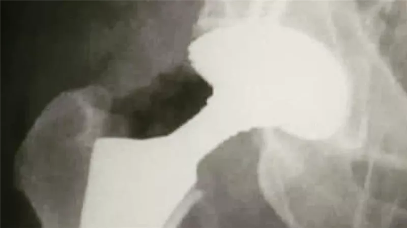 ما هي كسور عنق الفخذ؟