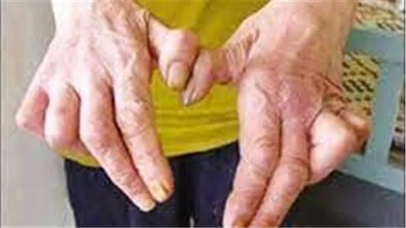 ماهو مرض الجذام؟